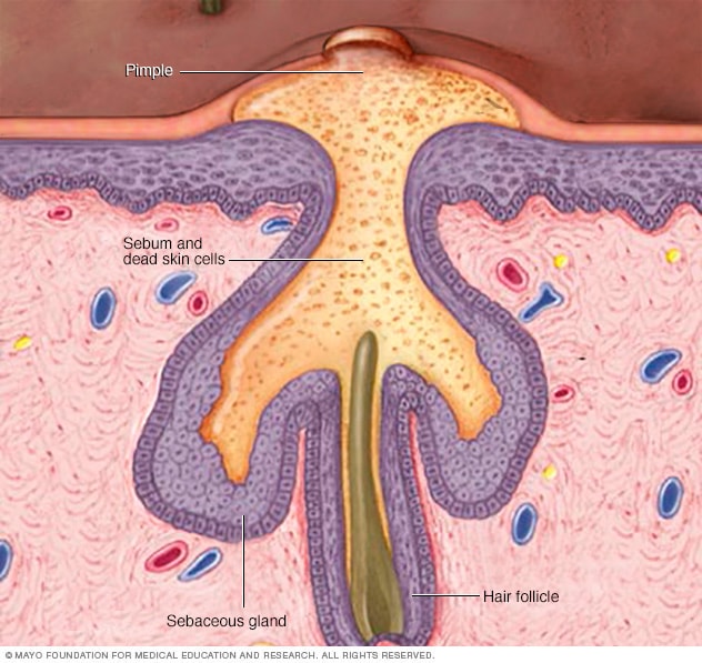 how-acne-develops-mayo-clinic