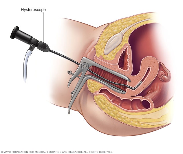Ilustración que muestra qué ocurre durante la histeroscopia