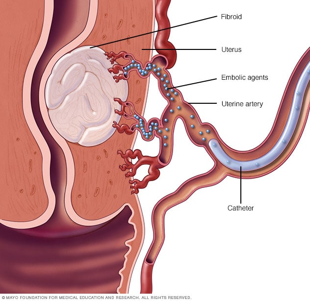Uterine Artery Embolization Mayo Clinic