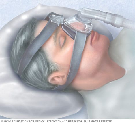 Apnea del sueño - Diagnóstico y tratamiento - Mayo Clinic