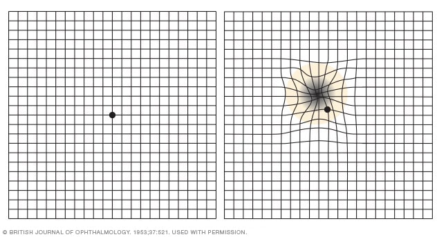 Amsler Grid Test for Retinal Conditions, When to See a Doctor