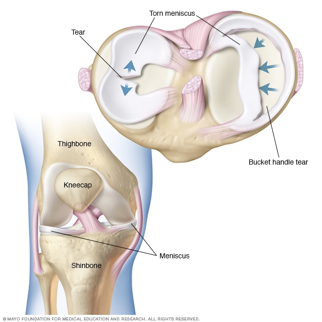 broken knee pain