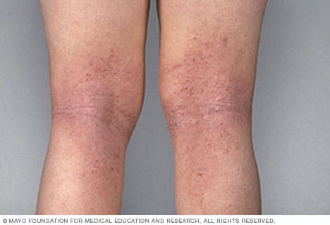 eczema bumps on elbows