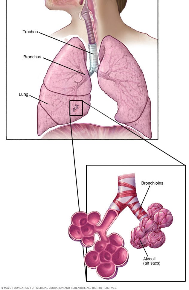 Bronquiolos y alvéolos en los pulmones - Mayo Clinic diagram of lung sections 