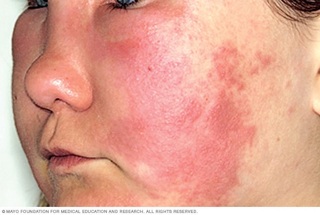 Hives On Face Treatment Doctor Heck