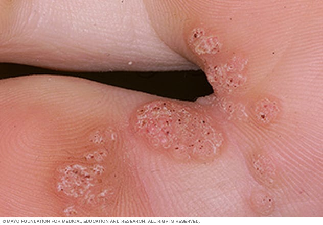28+ Tiny Hpv Warts On Hands Pictures