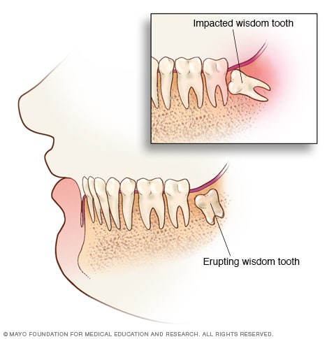 non impacted wisdom teeth