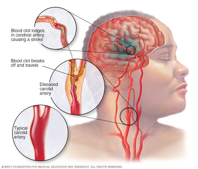 brain stroke case study