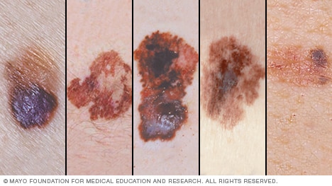 Presentación de diapositivas: Las imágenes de melanomas ...