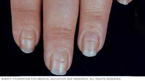 what causes horizontal ridges in fingernails