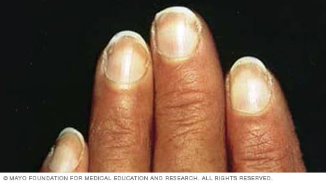 Help What Could My Finger Nail Mean Medically, The Nail Shape Look Deform -  Health - Nigeria