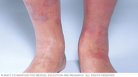 seborrhoeic dermatitis legs