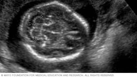 显示大脑底部的胎儿超声图像
