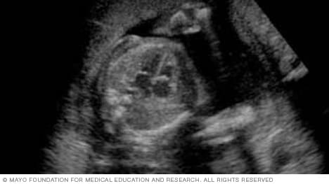 Imagen de ecografía que muestra las cavidades cardíacas de un feto