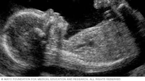 Ultrasound image showing a fetus in profile