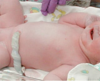 Foto de muñón del cordón umbilical de recién nacido