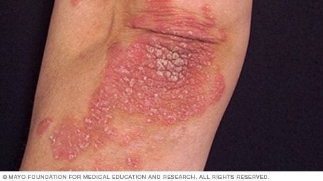 Slide Show: Types Of Psoriasis (psoriasis Pictures) - Mayo Clinic