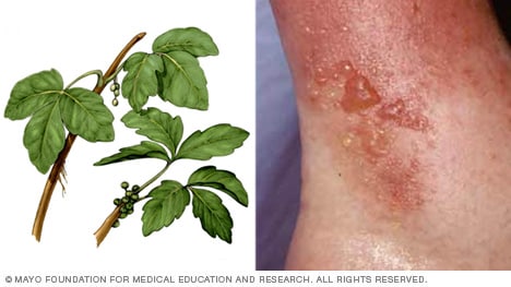Poison ivy and other summer skin irritants - Mayo Clinic