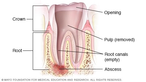 tooth pulp cavity slide