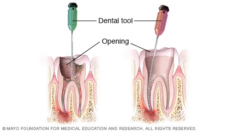 Ilustración que muestra la extracción de la pulpa afectada durante un procedimiento de endodoncia
