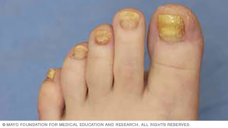 Reasons of Thick Toe Nails] 5 Causes you must know (II)