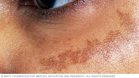 Slide show: Sun damage - Mayo Clinic