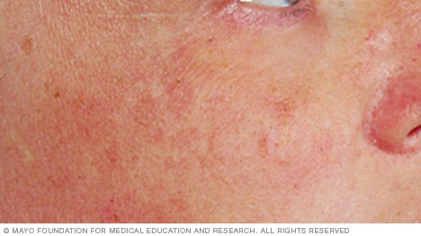sun damage pigmentation uneven skin spot dark solar lentigo elastosis slide mayo clinic exposure forehead lips labial previous next effects