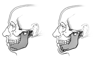 下巴整形手术图示，显示如何将下颚分开和前移。