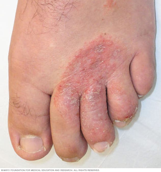 Athlete S Foot Symptoms And Causes Mayo Clinic