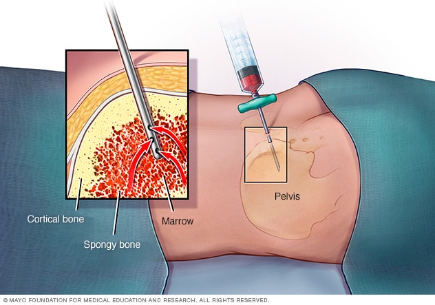 bone marrow core biopsy