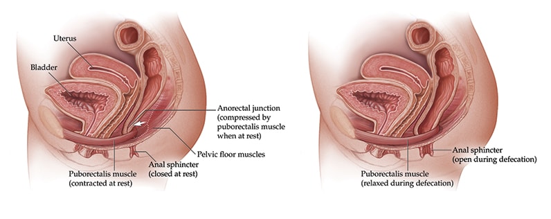 Ilustración del músculo puborrectal en reposo y durante la defecación