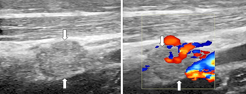 Neck ultrasound of patient with recurrent metastatic papillary thyroid cancer in a hypervascular right neck lymph node
