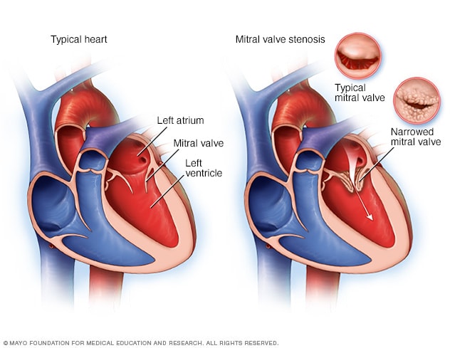 Corazón normal y corazón con estenosis de la válvula mitral