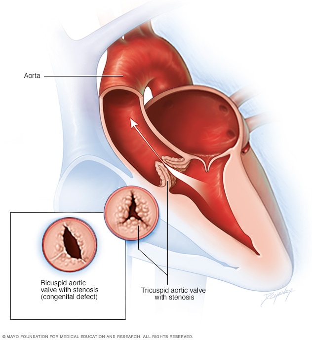 Aorta Artery Replacement Surgery