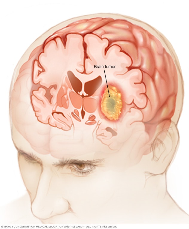 Brain Tumor Symptoms And Causes 2022