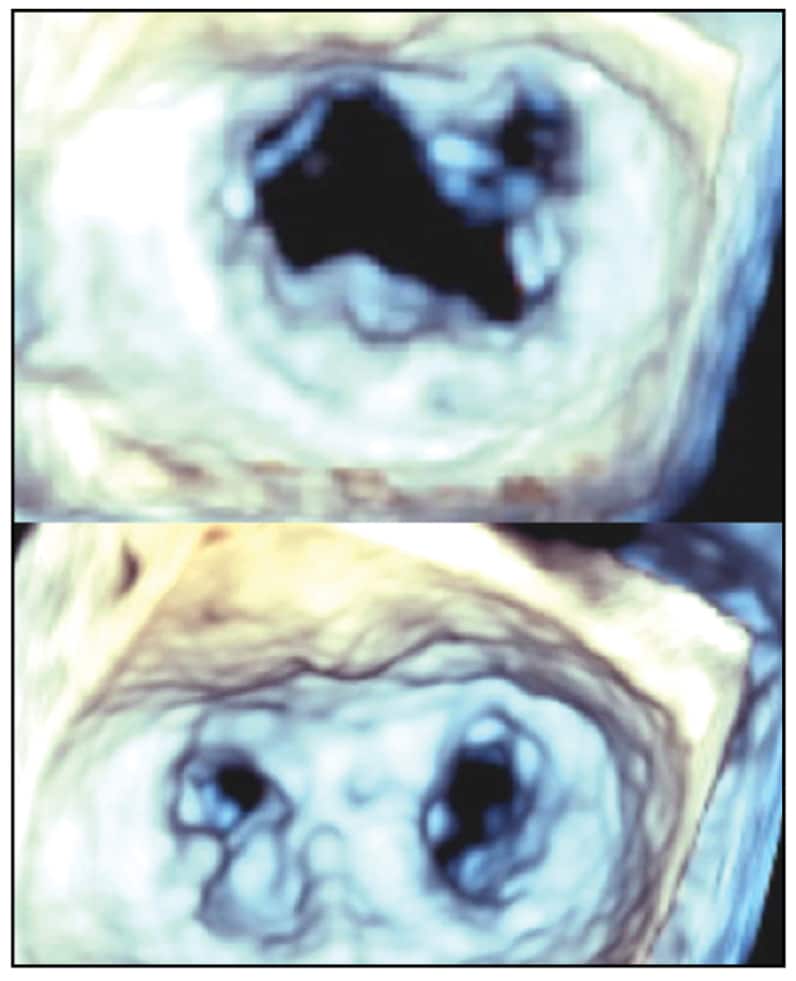 Image of mitral valve before and after repair