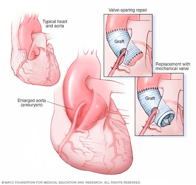 thoracic aortic aneurysm echocardiogram