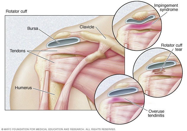 Rotator cuff injury - Symptoms and 