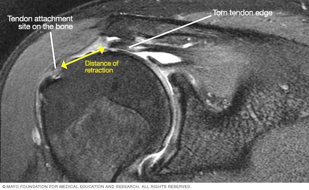 MRI of torn rotator cuff - Mayo Clinic