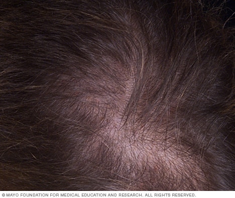 early female pattern baldness