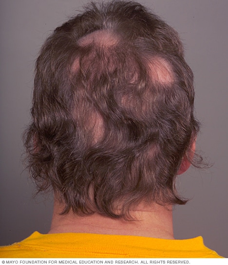 Which diseases cause hair loss
