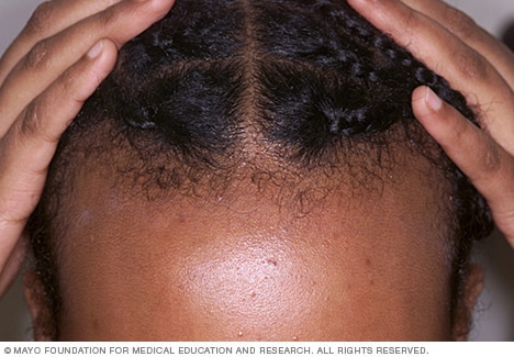 Male and female pattern hair loss Treatable and worth treating  Cleveland  Clinic Journal of Medicine