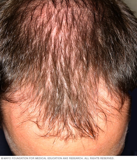Caída del cabello - y causas - Mayo Clinic