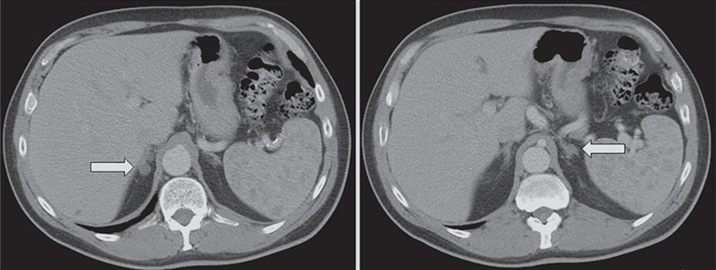 Adrenal computerized tomographic scan of a 59-year-old man with hypokalemia and poorly controlled hypertension