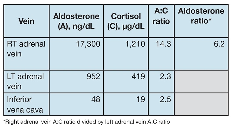 Table of results of bilateral adrenal venous sampling