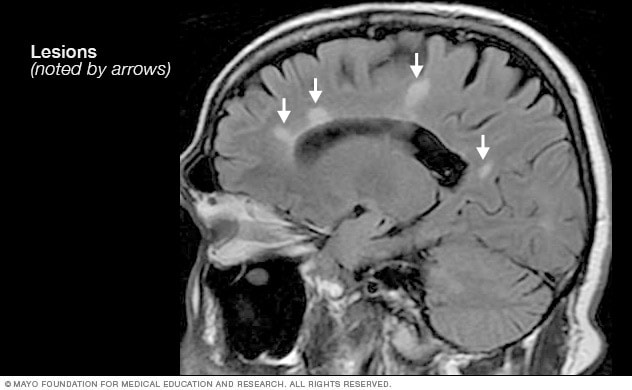 Neuro Brain Mri Multiple Sclerosis Lesions 8col 