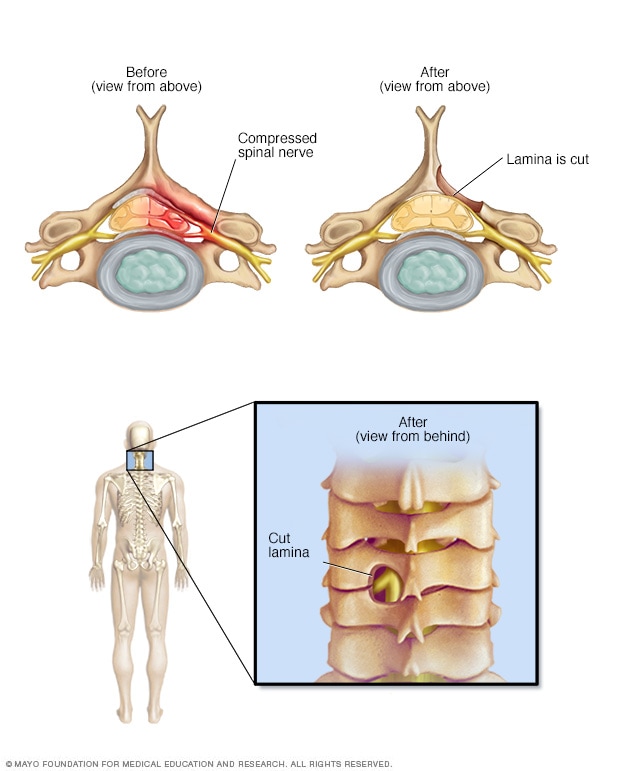 Treatment for Spinal Stenosis - Orthagenex