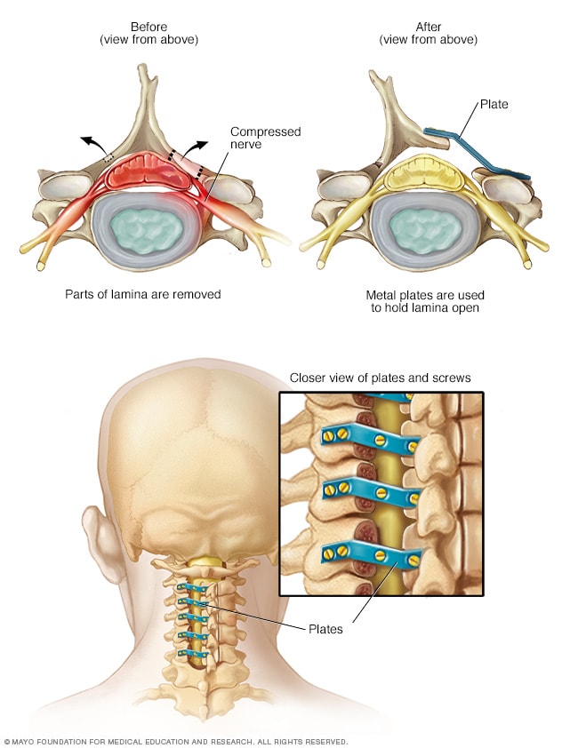 Spinal fusion - Mayo Clinic