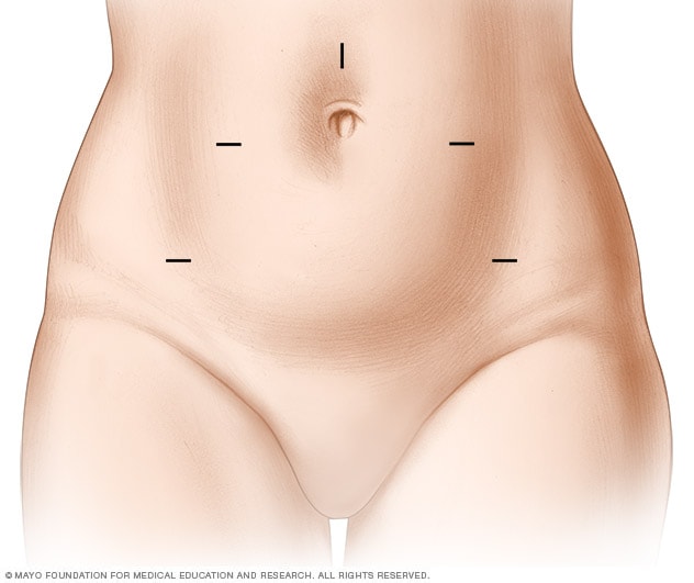 How to Find Comfort After a Hysterectomy