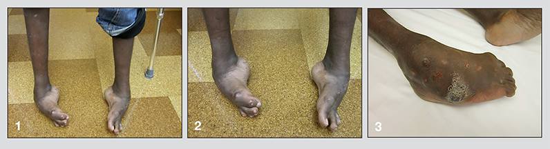 Patient's feet at initial visit